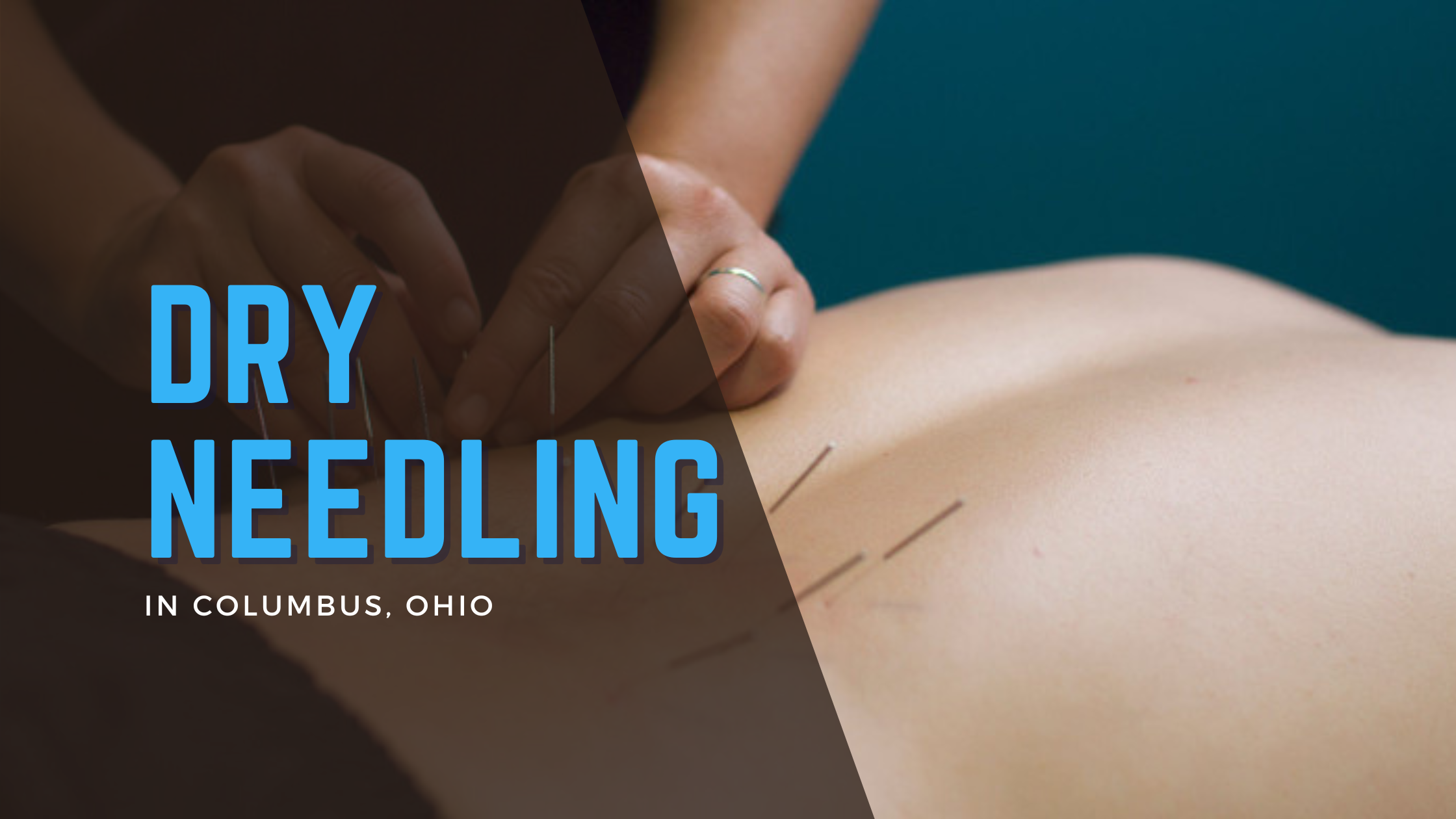 Dry Needling In Columbus, OH