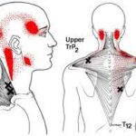 Shoulder Pain Trigger Point